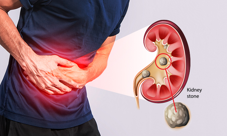 Kidney Stone
